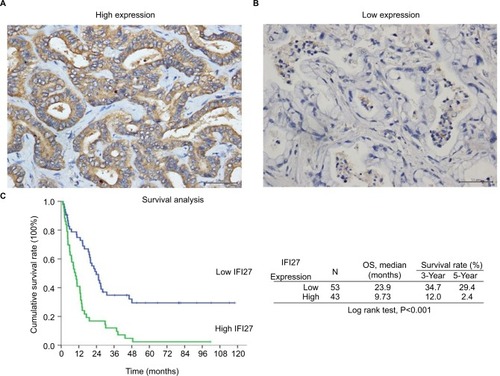 Figure 6 High IFI27 expression correlated with worse OS in MF-CCA patients.Notes: (A) The representative picture of high IFI27 expression. (B) The representative picture of low IFI27 expression. (C) The Kaplan–Meier plot of OS in patients with CCA after surgery based on IFI27 expression levels (scale bar =50 µm).Abbreviations: CCA, cholangiocarcinoma; IFI27, interferon α-inducible protein 27; MF, mass-forming; OS, overall survival.