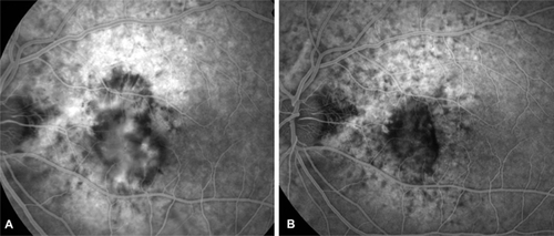 Figure 2 Left eye of patient 4. Fluorescein angiography A) before receiving PDT/IVTA (best-corrected visual acuity 20/200 [1 LogMAR]). FA B) shows reduction of fluorescein leakage and decrease in size of choroidal neovascularization 1 year after PDT/IVTA. Best-corrected visual acuity was unchanged.