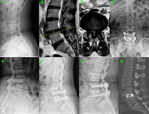Figure 4 A 67-year-old woman with degenerative spondylolisthesis was underwent the Endo-TLIF. (A) Preoperative lateral radiograph showed degenerative spondylolisthesis. (B and C) Preoperative MRI showed the spondylolisthesis and resultant stenosis (L4/5). The postoperative X-ray showed good clinical outcome at (D and E) 3 month, (F) 6 months and (G) 12 months after surgery, respectively. (H) CT scan image showed satisfied interbody fusion at 6 months after surgery.