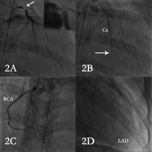 Figure 2. Coronary angiography showing thrombus of the left main coronary artery at its distal part (arrow) with zooming (A), abrupt obstruction (arrow) of the distal Circumflex artery (Cx) by emboli (B), normal RCA (C) which supply by retrograde course the occluded LAD artery (D).