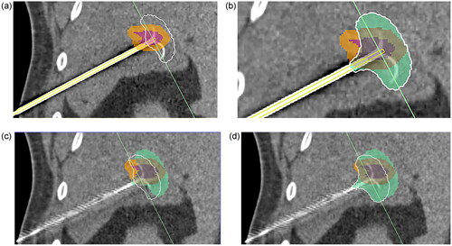 Figure 2. Screenshots of the coronal graphical display of registered and fused images after electrode deployment, initial ablation, and reposition for overlapping ablation. (a) Initial expected ablation volume: The segmented tumor (red) and margin (yellow) from the initial CECT were superimposed on the registered unenhanced electrode study. After designation of electrode, software provided multiplanar orthogonal images that depict tumor, margin, and expected ablation volume from nominal energy application (white outline). (b) The simulated ablation volume, calculated from the applied RF generator energy iis depicted in semi-opaque green. The untreated volume (unshaded) is distinct. (c) Plan expected overlapping ablation volume: Reconstructed registered and superimposed unenhanced image of repositioned electrode; the electrode was designated, and expected additional ablation volume depicted (white outline). (d) Assess accumulated simulation ablation volumes: The additional simulated ablation volume (semi-opaque green) has been added to depict the accumulation of treated tissue.