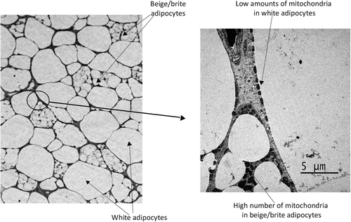 Figure 1. Presence of beige/brite adipocytes in visceral adipose tissue from a patient with pheochromocytoma. Left: light microscopy, indicating the presence of multilocular beige/brite adipocytes among other unilocular white adipocytes. Right: electron microscopy of the area indicated in the left, high mitochondrial content characteristic of beige/brite adipocyte phenotype is shown, as well as poor mitochondria presence in the cytoplasmic rim of white adipocytes.