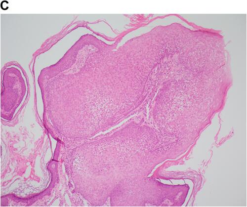 Figure 2 (A) Nevus sebaceous with overlying trichilemmoma: sebaceous gland proliferation in the dermis with overlying papillomatous projection of eosinophilic basaloid cells (H&E, ×40). (B) Sebaceous hyperplasia with vacuolated cytoplasm (H&E, ×200). (C) Trichilemmoma exophytic papillomatous projection of clear eosinophilic cuboidal palisaded cells (H&E, ×100).