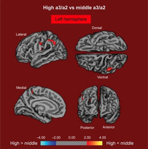 Figure 2 The red markings represent the brain regions with higher regional cortical thickness in MCI patients with high a3/a2 ratio as compared to MCI patients with middle a3/a2 ratio (P<0.01 uncorrected).