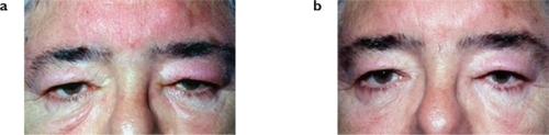 Figure 1 (a) Initial presentation: Bilateral eyelid oedema. Corneal reflexes can not be visualised on primary position. (b) Nine months later: improvement of periorbital oedema. Both corneal reflexes are visible on primary position.