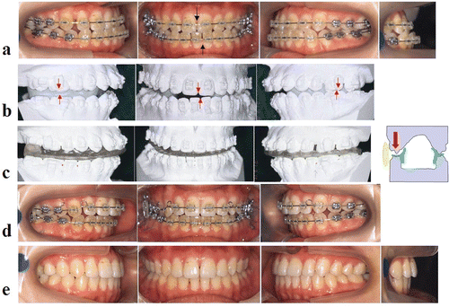 Figure 14. Occlusal findings. (a) Pre-surgical recording. (b) Final mandibular positioning in ManMoS prediction. (c) Fabrication of the occlusal splint (vertical elastic was applied to extrude the upper molar on the right side during the intermaxillary fixation period). (d) Two weeks after surgery (at the end of the intermaxillary fixation). (e) Eight months after surgery (at the end of the post-surgical orthodontics). [Color version available online.]