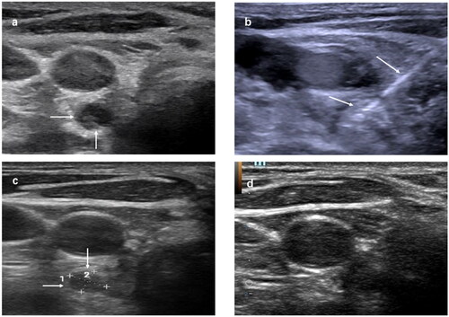 Figure 1. Recurrent papillary thyroid cancer at left level 3 after thyroidectomy and RI therapy in a 35-year-old female. (a) Transverse ultrasound image showing a 0.7-cm-sized hypoechoic mass at right level 6 (arrows). (b) An internally cooled electrode with a 1.5-cm-sized active tip was inserted into the recurrent tumor (arrows). (c) One month after RFA, the US scans showed the treated tumor had decreased with 79% VRR (d). Six months after RFA, the treated tumor was not found on US. RI: radioactive iodine; RFA: radiofrequency ablation; US: ultrasound.