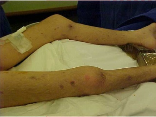 Figure 4 Skin lesions, characteristic aspect of deep lesions and diffuse distribution.