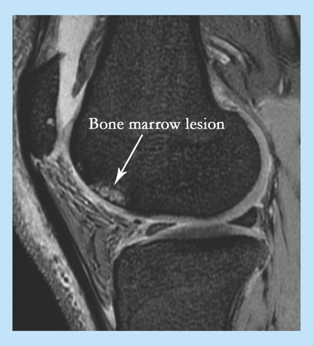 Figure 1.  MRI of knee osteoarthritis showing bone marrow lesion.