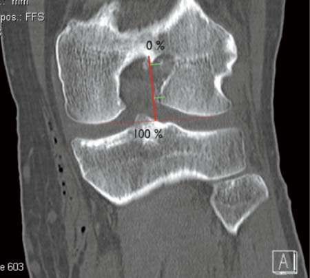 Figure 1. Measurement of the femoral tunnel on the coronal CT reconstruction, performed according to Hoser et al. (Citation2005). The tunnel is measured in comparison to the line perpendicular to the most distal points of the femoral condyles. The measurement is compared to the line from the intracondylar roof to the distal femoral condyles.