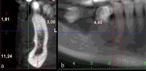 Figure 3. Cross-sectional (a) and sagittal (b) CBCT images showing the measurements for anterior loop morphology.