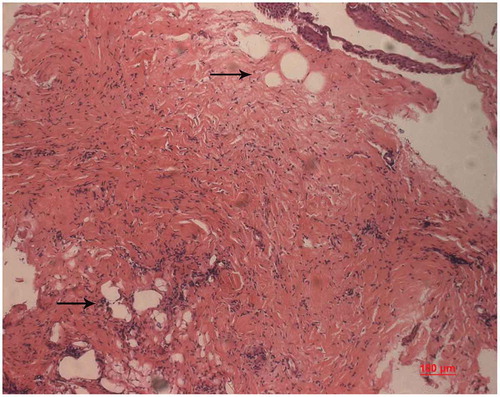 Figure 5. Light micrograph of the membrane over the anterior plate. Squamous epithelia adhere loosely to the fibrovascular tissue, Lacunae are demonstrated adjacent to the epithelial layer and over the optic (arrow, HE) .