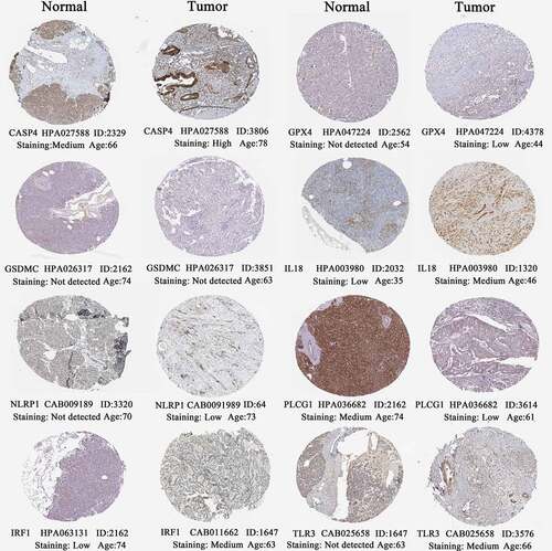 Figure 8. The histological expressions of 8 risk pyroptosis-related genes. The top of the figure indicates the category of tissue specimen. The name of pyroptosis regulator, the antibody type, the patient ID, and the staining intensity are listed at the bottom of each image.