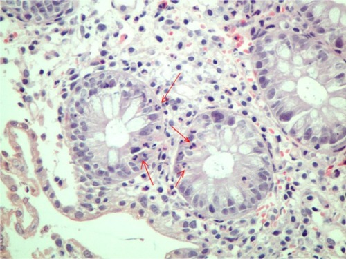 Figure 2 Polymorphonuclear infiltration of crypt mucosal cells (arrows).