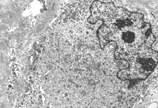 FIG. 3 Conventional electron microscopy of a rhabdoid cell from the tumor, demonstrating whorls of intermediate filaments, × 10,400.