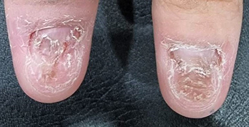 Figure 1 Both thumbnails showed signs of nail dystrophy, including discoloration, loss of cuticles, abnormal shape, depressions in the middle of the nail plate, and thick, flaky scales on the surface.