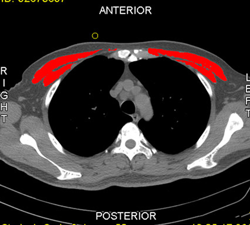 Figure 1 The cross-section of the chest CT image at the 4th thoracic vertebra and the red marking area was the PMA.