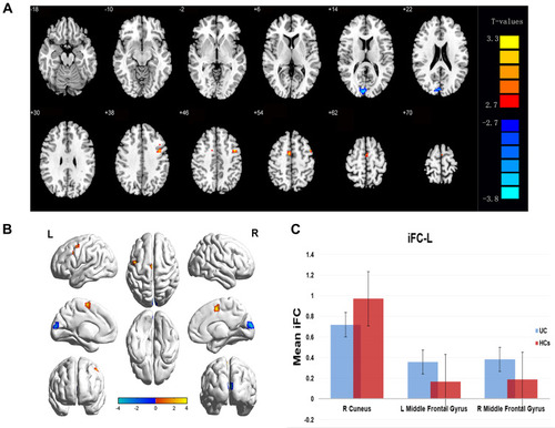 Figure 1 Differences in FC of the left V1 between patients with CU and HCs.