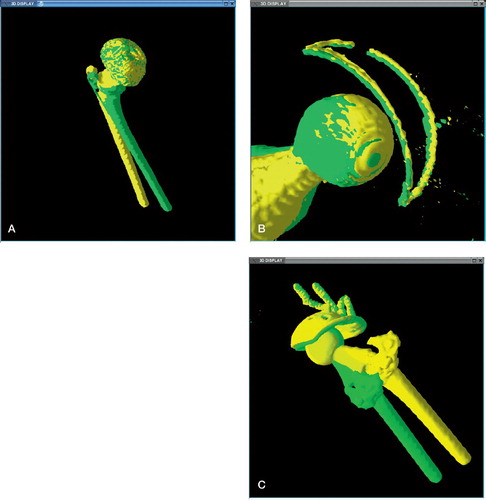 Figure 2. 3D shaded superimposed displays of implant after volume registration of the pelvis. A. Stable uncemented implant after registration. Note how the two colors mix, indicating no detectable movement of the cup. The femoral stem has not been matched, due to movement of the leg from internal to external rotation. The striations are an artifact of the limited resolution of the CT data. B. Loose cemented implant; note the subtle tilting of the metal wire marker in the cup. C. A loose cemented implant and acetabular cage. Note better matching of broken screws incorporated in the registered pelvis, than in the rest of the implant, which has moved between the scans.