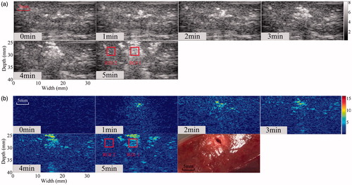 Figure 12. Temporal evolution of ultrasonic (a) B-mode and (b) Δα0 images of MWA-induced thermal lesion in an in vivo porcine kidney during MWA treatment. The regions of interest (ROI) are the MWA-induced thermal lesion and surrounding normal tissue. Both regions of interest are 3 × 3 mm.