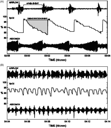 Figure 1. Two patients with apneas and associated oxygen desaturation events with different characteristics. Patient A has longer apneas and deeper oxygen saturation drops, but as they occur more seldom. Patient B has shorter apneas and shallower oxygen saturation drops occurring more frequently and therefore also higher AHI.