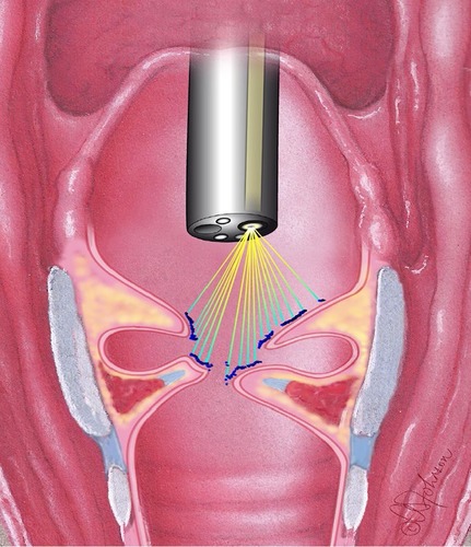 Figure 6 The relationship between the scanning laser beam and the “profile” offered by the larynx ruler data interpretations.