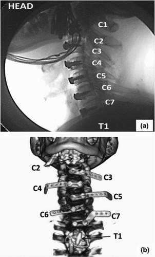Fig. 5 PMHS cervical instrumentation (PMHS08) for the sled tests: (a) fluoroscopic image and (b) 3D CT reconstruction.