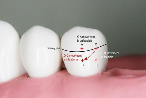 Figure 16 Clasp movement (from O) under loading.