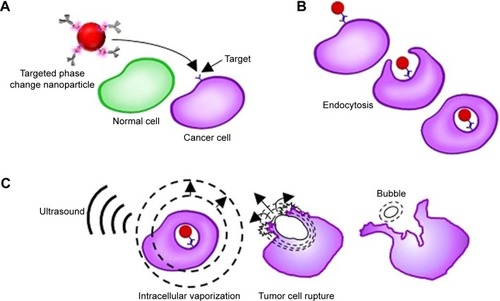 Figure 5 Schematic explaining the synergistic treatment of ultrasound with targeted liquid fluorocarbon droplets.