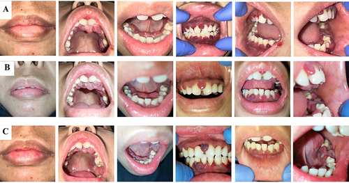 Figure 3 (A) The follow-up visit was nine days after the initial visit. (B) The follow-up visit was one month after the initial visit. (C) The follow-up visit was one week after the 4th visit. Gingival enlargement decreased in all regions.