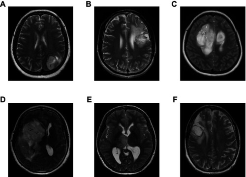 Figure S2 Representative MRI images of various glioma subtypes. (A) Glioblastoma (WHO IV); (B) Astrocytoma (WHO III); (C) Astrocytoma (WHO II); (D) Oligodendroglioma (WHO III); (E) Oligodendroglioma (WHO II); (F) Oligoastrocytoma (WHO II).