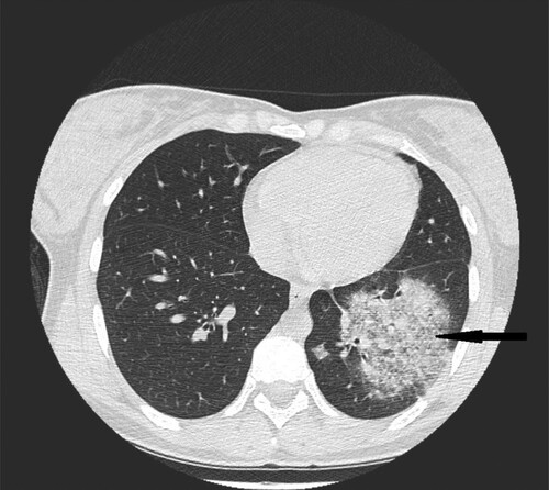 Figure 7. 28-year-old female with congenital neutropenia presenting with productive cough and fever. High resolution CT scans obtained at level of lower lobes shows massive consolidations with air- bronchogram located in basal segments of left lower lobe (black narrow arrow).