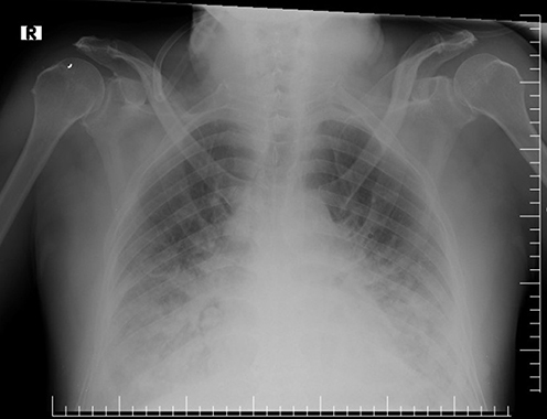 Figure 2 A chest X-ray showed bilateral pulmonary edema.