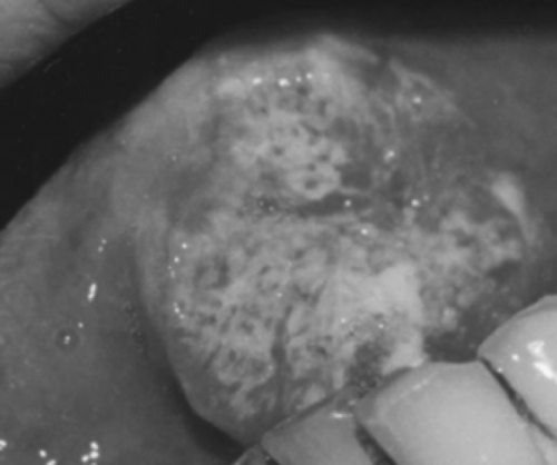 Figure 2 A tongue carcinoma before lingual arterial chemoembolization.