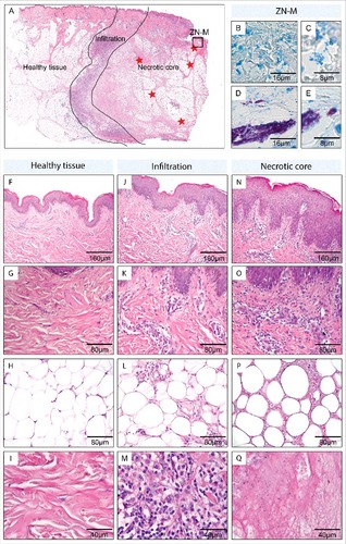 Figure 2. In depth analysis of the skin tissue in the necrotic core, the infiltrated area and the healthy tissue area (patient 5). Sections were either stained with Haematoxylin-Eosin (HE; A, F-Q) or Ziehl-Neelsen/Methyleneblue (ZN-M; B-E) according to the WHO standard protocol.Citation1 Pictures were either taken with a Leica DFC 420C camera or with an Aperio ScanScope XT. A: Overview of the histopathological section from patient 5, depicting the 3 regions (healthy tissue, infiltration, necrotic core) which were found in all early ulcerative lesions. Healthy tissue (F-I) presented with a normal epidermal layer (F), no sub- epidermal infiltration (G), healthy fat cells (H) and intact collagen fibers (I). The infiltrated area (J-M), separating the healthy tissue from the necrotic core, reflected a transition state with a slight thickening of the epidermal layer (J), some sub-epidermal infiltration (K), fat cells which started to round up and shrink (L) and the accumulation of large numbers of infiltrating cells (M). The necrotic core (N-O) presented with strongly elongated rete ridges and an epidermal layer which was more than 3 times thicker than the healthy epidermis (N), a strong sub-epidermal infiltration which was largest above the necrotic core (O), fat cell ghosts which displayed signs of cell death (rounding up, shrinkage, absence of nuclei) (P) and necrotic connective tissue without collagen fibers (Q). In the necrotic core focally clustered AFB (D, E, red stars in A) as well as a secondary infection (B, C; at the open ulcer surface (black box A)) could be observed