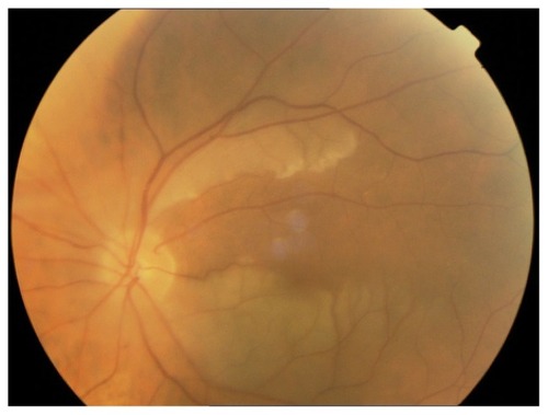 Figure 2 Fondus oculi-shows a more advanced stage of the ilness, where pailness of the optic disc and extended ischemic areas.