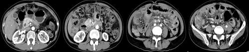 Figure 5 CT scan shows the tumor in gall bladder and metastatic lymph nodes on December 31, 2021.