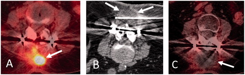 Figure 2. 60-year-old woman with metastatic peripheral nerve sheath tumor previously managed by surgical resection and adjuvant chemoradiation therapy presenting with recurrent tumor involving upper lumbar vertebral posterior elements and paraspinal soft tissues. Axial FDG-PET-CT image (A) shows hypermetabolic soft tissue mass within posterior upper lumbar paraspinal soft tissues (A, arrow). Prone axial (B) CT image during cryoablation shows placement of a cryoprobe (a total of 3 cryoprobes were used) within the lesion with hypoattenuating ice ball encompassing the tumor volume (B, arrows). Axial FDG-PET-CT image obtained 3 months following cryoablation (C) shows local tumor control with no evidence of residual or recurrent tumor (C, arrow).