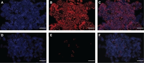 Figure 10 Postirradiation effects after intra-arterial administration of HSA-MWCNTs. TUNEL TMR apoptosis assay (red), DAPI nuclear staining (blue), and overlay. A–C) Pancreatic adenocarcinoma. D–G) Normal pancreatic tissue. Scale bar: 100 μm. Results are representative of three experiments.Abbreviations: DAPI, 4′,6-diamidino-2-phenylindole; HSA, human serum albumin; MWCNT, multiwalled carbon nanotubes; TUNEL, transferase dUTP nick end labeling.