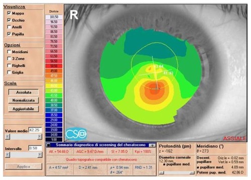 Figure 5 Eighteen-month postoperative topographic corneal map of patient (MG) from group 2.