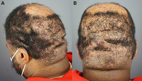 Figure 1 CVG and widespread AKN papular lesions: patient 1 with CVG onset within two years of AKN starting in the nuchal area: left posterior head (A) and posterior oblique head (B) view showing widespread AKN and CVG.