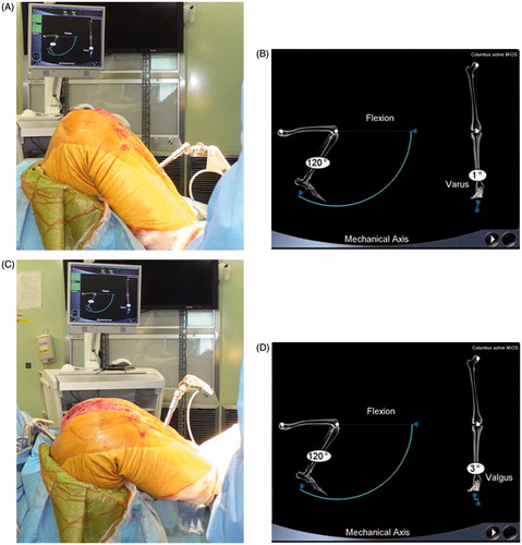 Figure 1. The joint component gap was measured manually as guided by a navigation system. Photograph (A) and screen shot (B) show varus stress at 120°. Photograph (C) and screen shot (D) show valgus stress at 120°. Screen shots show 1° varus in varus stress (B) and 3° valgus in valgus stress (D); thus medio-lateral laxity (soft tissue balance) was calculated as 4°.