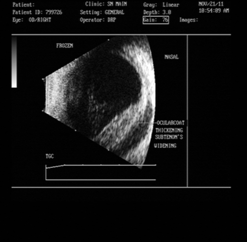 FIGURE 1  USG Bscan of right eye showing an irregular mass lesion within the ocular coats.