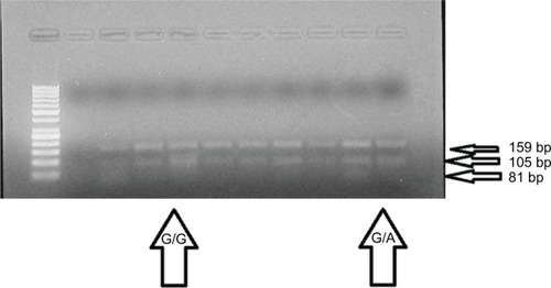 Figure 1 Identification of IRS1 gene polymorphism (r.2963G>A) using PCR-RFLP method.