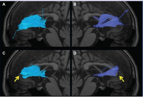 Figure 5 The anterior thalamic radiation superimposed on a T1-weighted sagittal image in an AD patient. (A and B) Several radiations passing the bilateral genus of the corpus callosum and extending to the prefrontal area are observed. (C and D) The radiations passing the bilateral genus of the corpus callosum and extending to the prefrontal area were lost by setting the threshold of the FA value at 0.24, and depiction can be readily judged as poor (arrow).