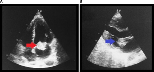 Figure 1 (A) Apical four-chamber view. (B) Long axis view.Notes: (A) The red arrow shows the mass in the mitral valve during diastole. (B) The blue arrow shows a mass in the anterior leaflet of the mitral valve.
