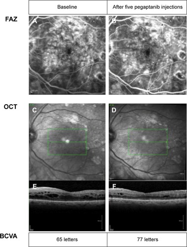 Figure 5 Example of a patient who benefitted from treatment.