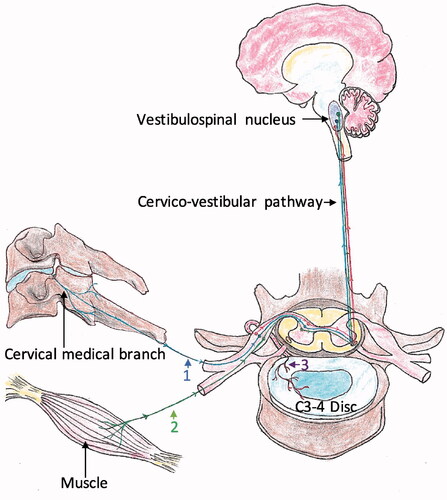 Figure 1. The pathological pathway of cervical dizziness between cervical structures and vestibulospinal nucleus. Pathway 1: originating from mechanoreceptors in the facet joint; pathway 2: originating from muscle spindles; pathway 3: originating from mechanoreceptors in intradiscal endings.