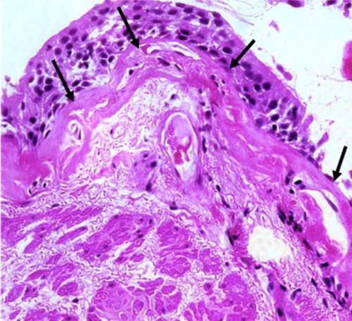 Figure 1 Rbm fragmentation in COPD.