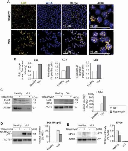 Figure 1. Human platelets isolated from Vici syndrome-patient demonstrate increased LC3 protein levels and accumulate SQSTM1/p62. (A) Freshly isolated platelets from a healthy subject or pediatric patient with Vici syndrome were fixed in suspension immediately after isolation. Representative images are shown. Immunofluorescence staining with an anti-LC3 (yellow) antibody demonstrates expression of increased levels of LC3 in platelets from patient with Vici syndrome when compared to healthy platelets (scale bars: 10 µm). Cells were co-stained using WGA (which binds to glycoproteins of the cell and granule membrane, blue). The yellow box in the merge image demonstrates the origins of the 400x images. (B) Micrographs were analyzed using CellProfiler. The bar graphs display the fold change of mean fluorescent intensity (left, healthy in white and patient with Vici syndrome in gray), fold change of positively stained cells (middle), and fold change of stained particles/positive stained cell (right). (C) Immunoblot analysis of platelet lysates from healthy and Vici patient platelets (± rapamycin to induce autophagy) using an anti-LC3 antibody. Corresponding ACTB/actin as a loading control is depicted (bottom). Molecular masses of the respective proteins are indicated. Left blot with unequal ACTB loading demonstrates that LC3 is present in healthy platelets. The quantitative analysis of LC3-II:ACTB ratio, is shown. (D) Immunoblot analysis of platelet lysates from healthy and Vici-patient platelets (± rapamycin to induce autophagy) using an anti-SQSTM1/p62. Corresponding ACTB as a loading control is depicted (bottom). The quantitative analysis of SQSTM1/p62:ACTB ratio is shown. (E) Immunoblot analysis of platelet lysates from healthy and Vici-patient platelets (± rapamycin to induce autophagy) using an anti-EPG5 antibody. Corresponding ACTB as a loading control is depicted (bottom). The quantitative analysis of EPG5:ACTB ratio is shown. For bar graphs in C, D, and E, non-treated (NT, light gray), and rapamycin (dark gray).